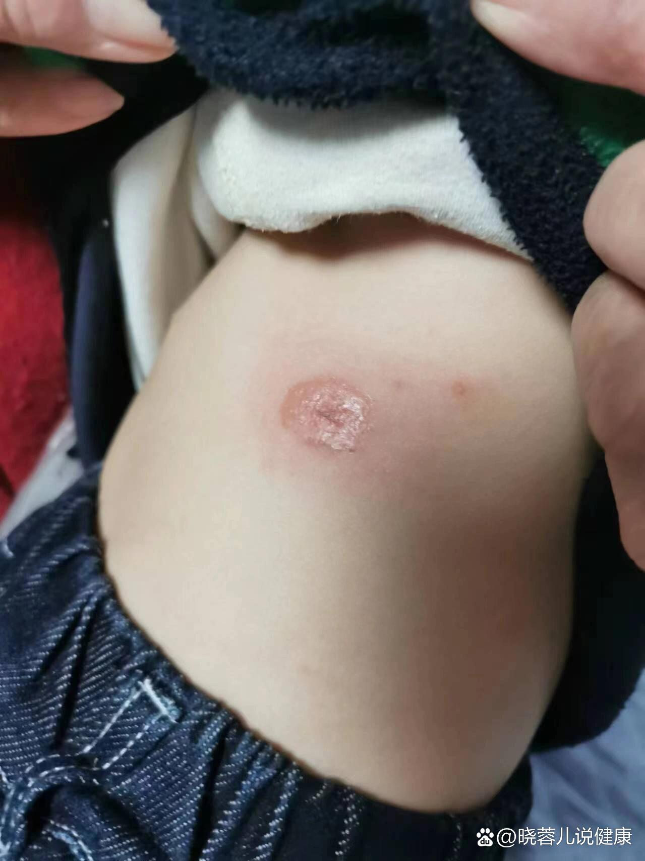 觐冡锆爆<瘡的简单介绍